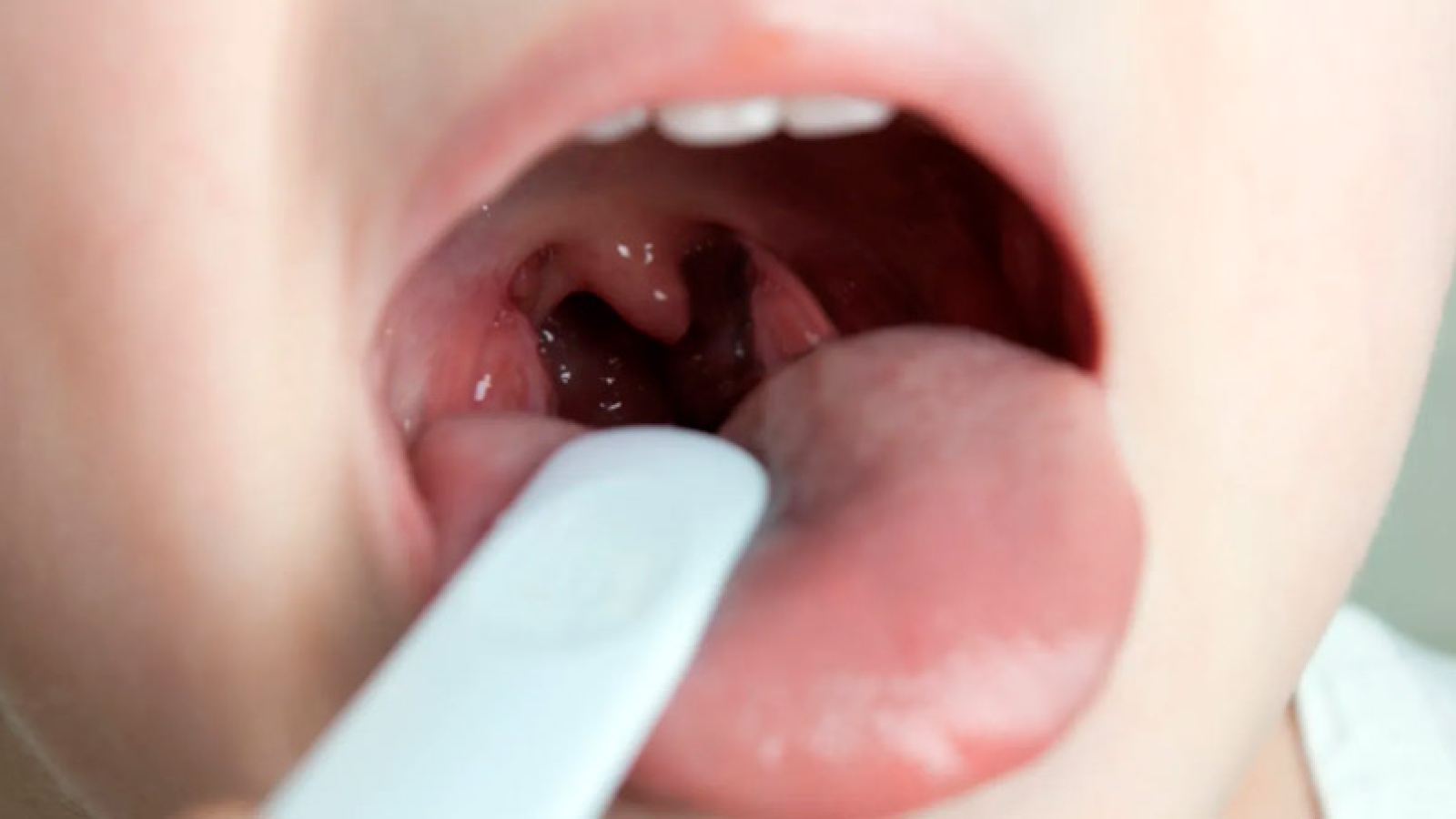 otorrinoeotoneuro-amigdalas-e-adenoide-o-que-saber