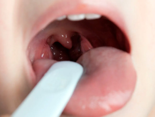 otorrinoeotoneuro-amigdalas-e-adenoide-o-que-saber