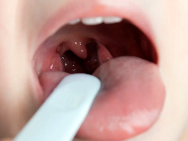 otorrinoeotoneuro-amigdalas-e-adenoide-o-que-saber